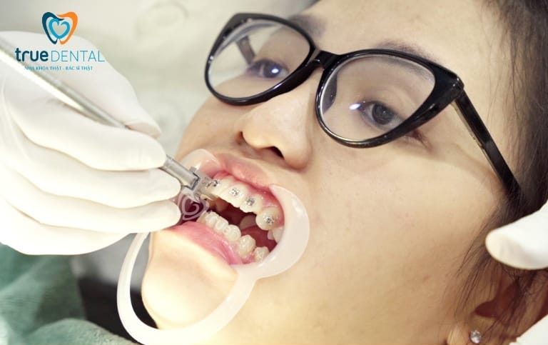 True Dental niềng răng tốt hơn các nha khoa khác không