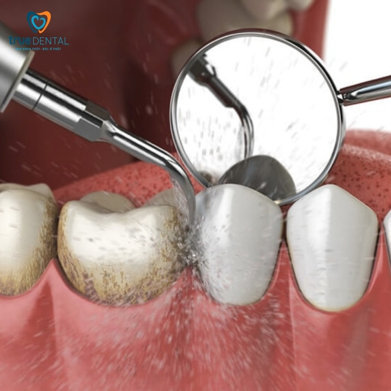 cạo vôi răng Quận 3 uy tín