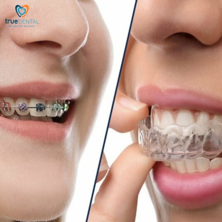 niềng răng hai hàm giá bao nhiêu TPHCM