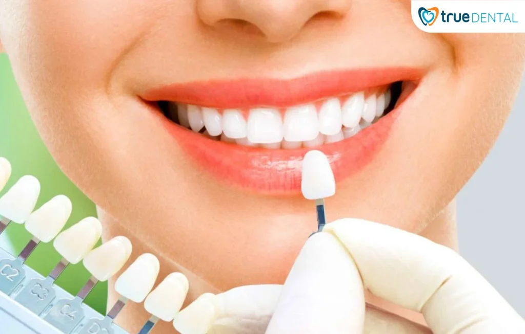 Sứ thẩm mỹ True Dental bảo hành bao lâu? Giải đáp đầy đủ và bảng giá cập nhật 2026 12 sứ thẩm mỹ True Dental bảo hành bao lâu